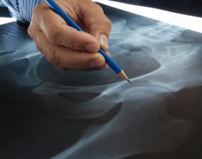 Stryker hip recall lawsuit